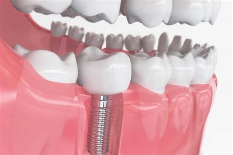 ¿Vitrigel: Una Maravilla Biocompatible para Implantes Dentales del Futuro?