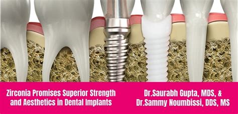  ¿Zirconio: El Material del Futuro para Implantes Dentales de Alta Resistencia?